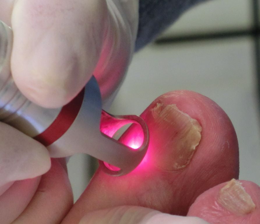Tratamiento LASER de Onicomicosis (hongos en uñas)